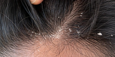 Seborrheic Dermatitis
